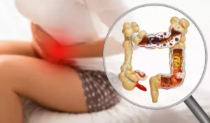 Ilustrácia ženy so silnou bolesťou brucha so zvýrazneným hrubým črevom a zväčšeným slepým črevom – vizuálny symbol zápalu slepého čreva (apendicitídy).