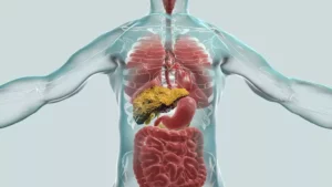 Schéma ľudského tela so zvýraznenou pečeňou a žlčovodmi, znázorňujúca poškodenie žlčových ciest pri primárnej biliárnej cholangitíde (PBC).