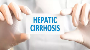 Ilustrácia pečene s jazvovitým, hrboľatým povrchom, znázorňujúca cirhózu (tvrdnutie pečene) a jej vplyv na štruktúru a funkciu orgánu.