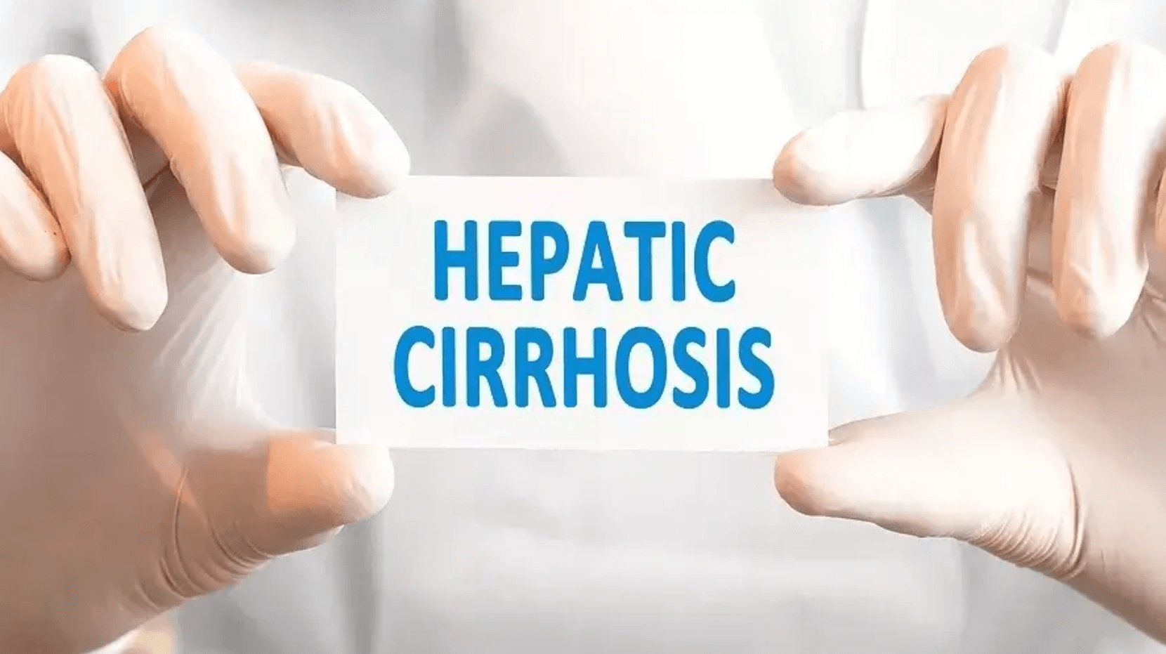 Ilustrácia pečene s jazvovitým, hrboľatým povrchom, znázorňujúca cirhózu (tvrdnutie pečene) a jej vplyv na štruktúru a funkciu orgánu.