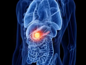 Modrý anatomický obrázok ľudského tela so zvýrazneným pankreasom v strede brucha – vizualizácia miesta a výskytu rakoviny pankreasu.
