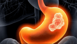 Schéma žalúdka so zvýrazneným zhubným nádorom – rakovina žalúdka, príznaky, liečba, prevencia.