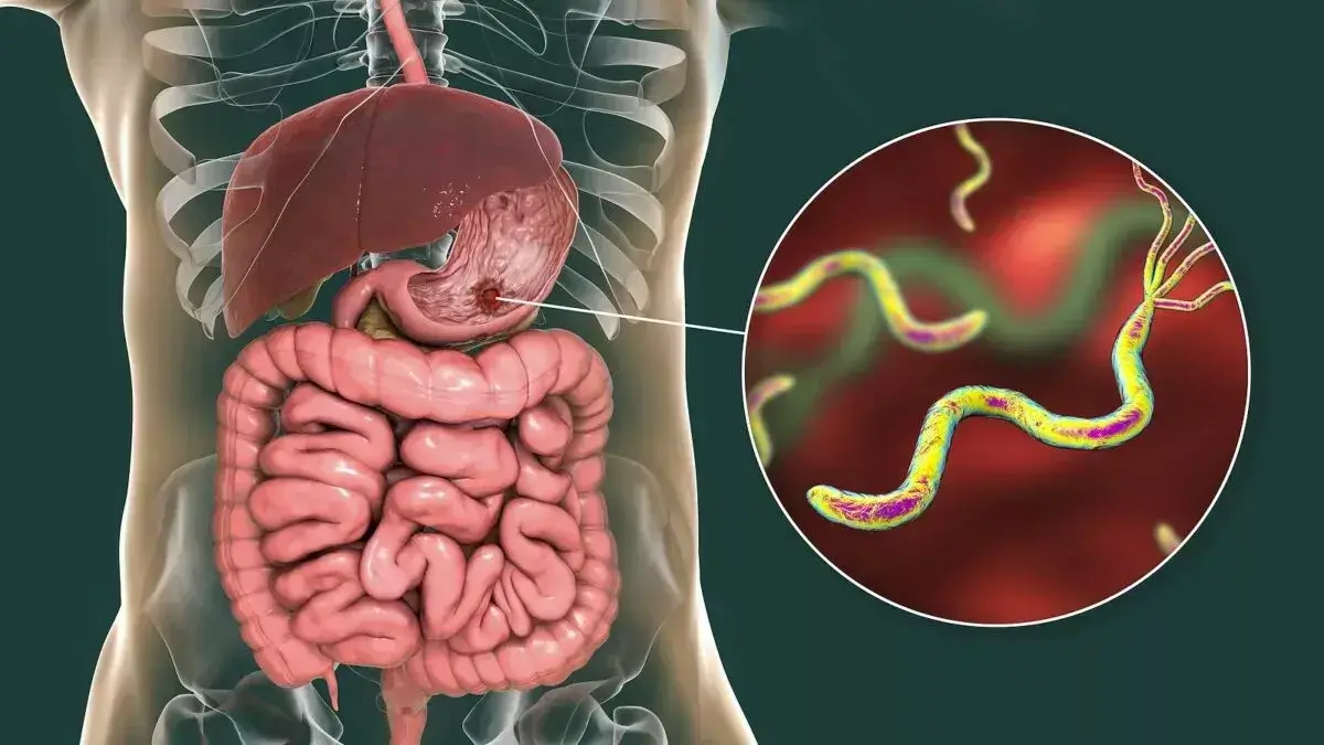 Špirálovitá baktéria Helicobacter pylori v ľudskom žalúdku – hlavný pôvodca žalúdočných vredov.