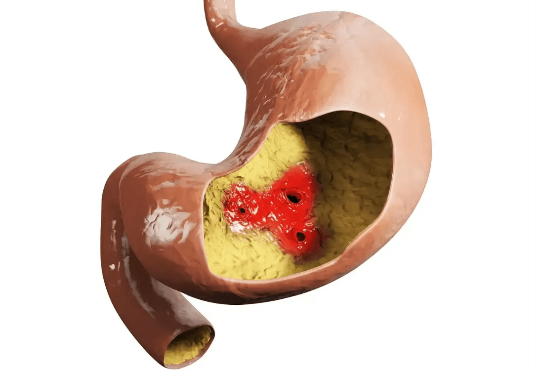 Ilustrácia žalúdka s výrazným červeným vredom na sliznici, znázorňujúca poškodenie typické pre žalúdočné vredy