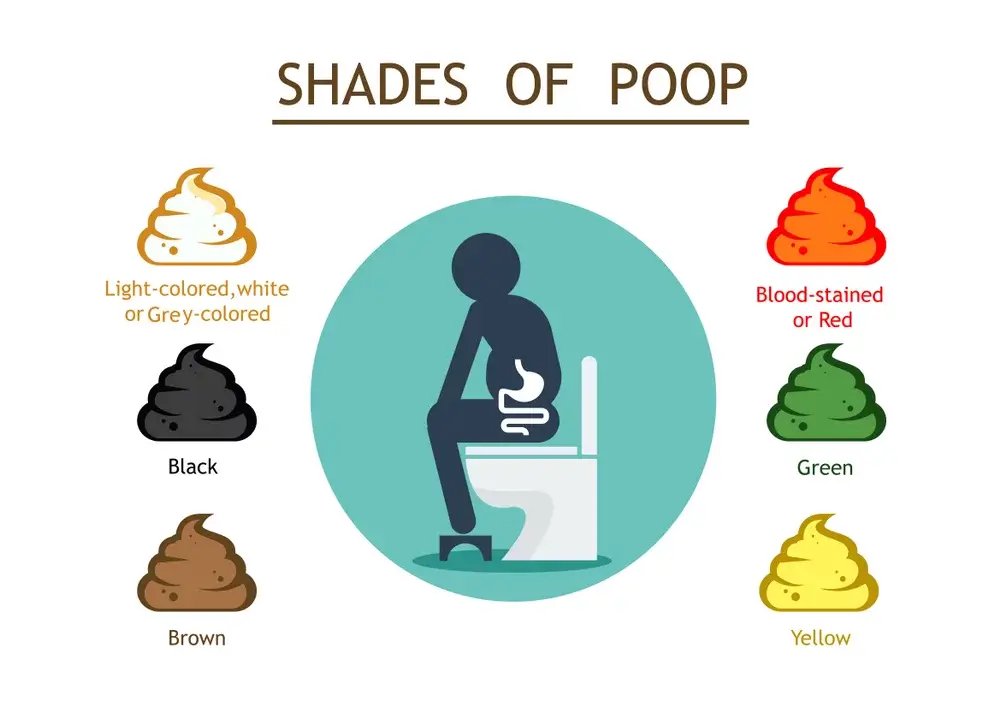 Zelená stolica v toaletnej mise, ilustrácia odlišnej farby stolice ako príznaku vplyvu stravy, liekov alebo tráviacich ochorení.