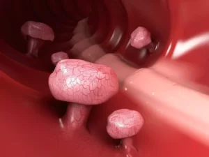 Schéma črevného polypu na sliznici hrubého čreva, znázorňujúca výrastok a jeho možné príznaky – črevný polyp, prevencia, zdravie čriev.