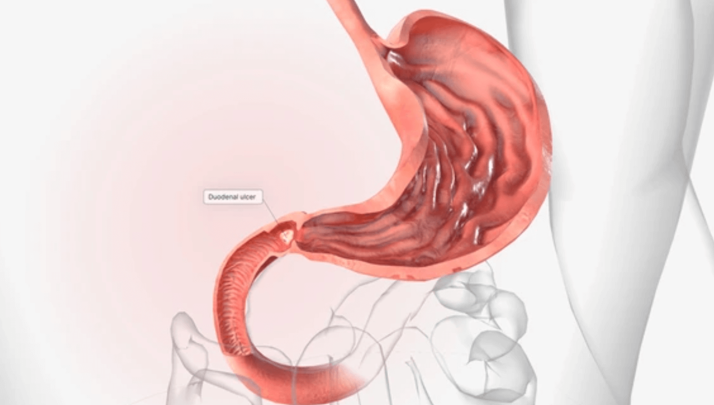 Ilustrácia: schéma tráviaceho traktu so zvýrazneným dvanástnikom a vredovou léziou v jeho stene, znázorňujúca lokalizáciu a podstatu dvanástnikového vredu.
