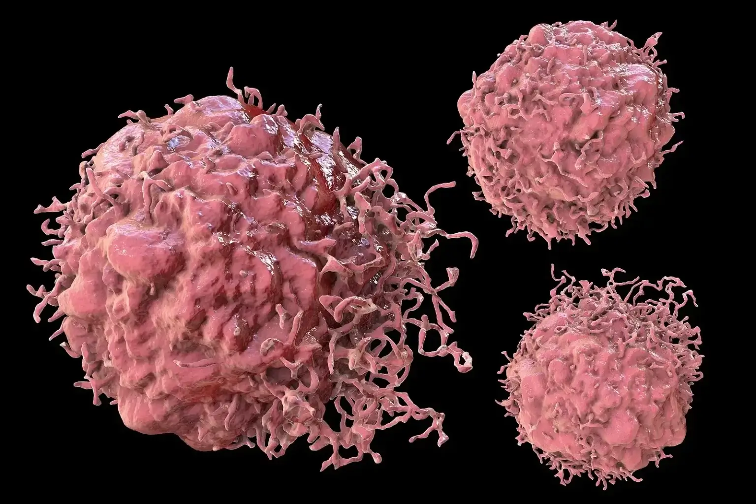 Detailný 3D pohľad na rakovinové bunky konečníka – ilustrácia typická pre článok o príznakoch rakoviny konečníka.